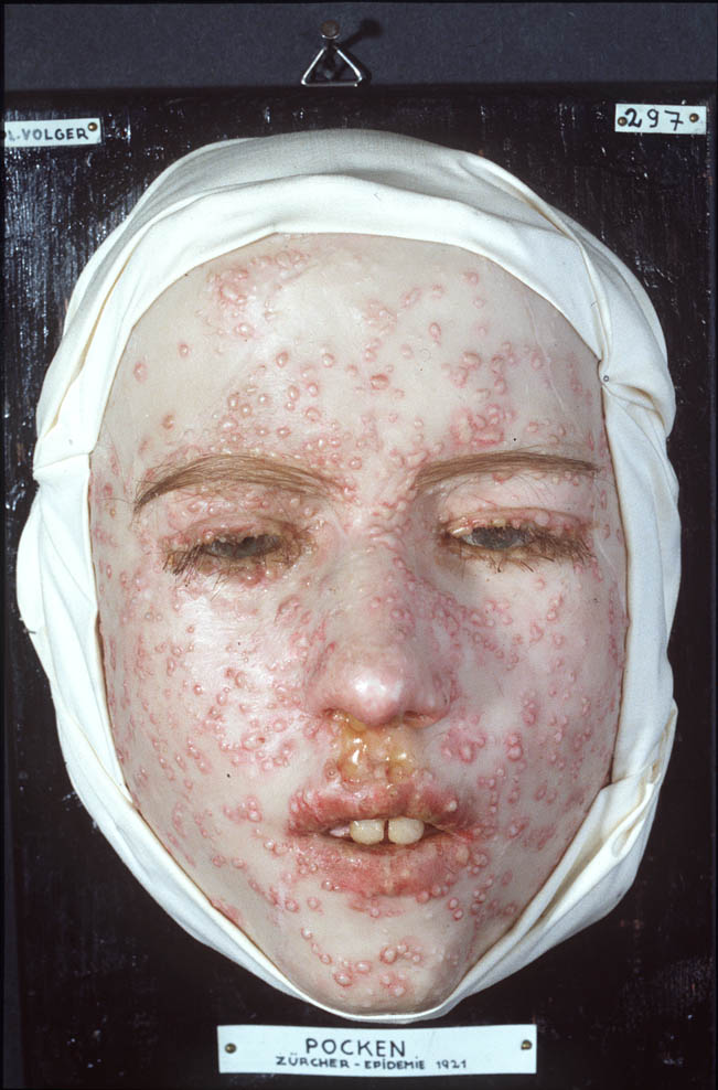 Moulage of face with smallpox