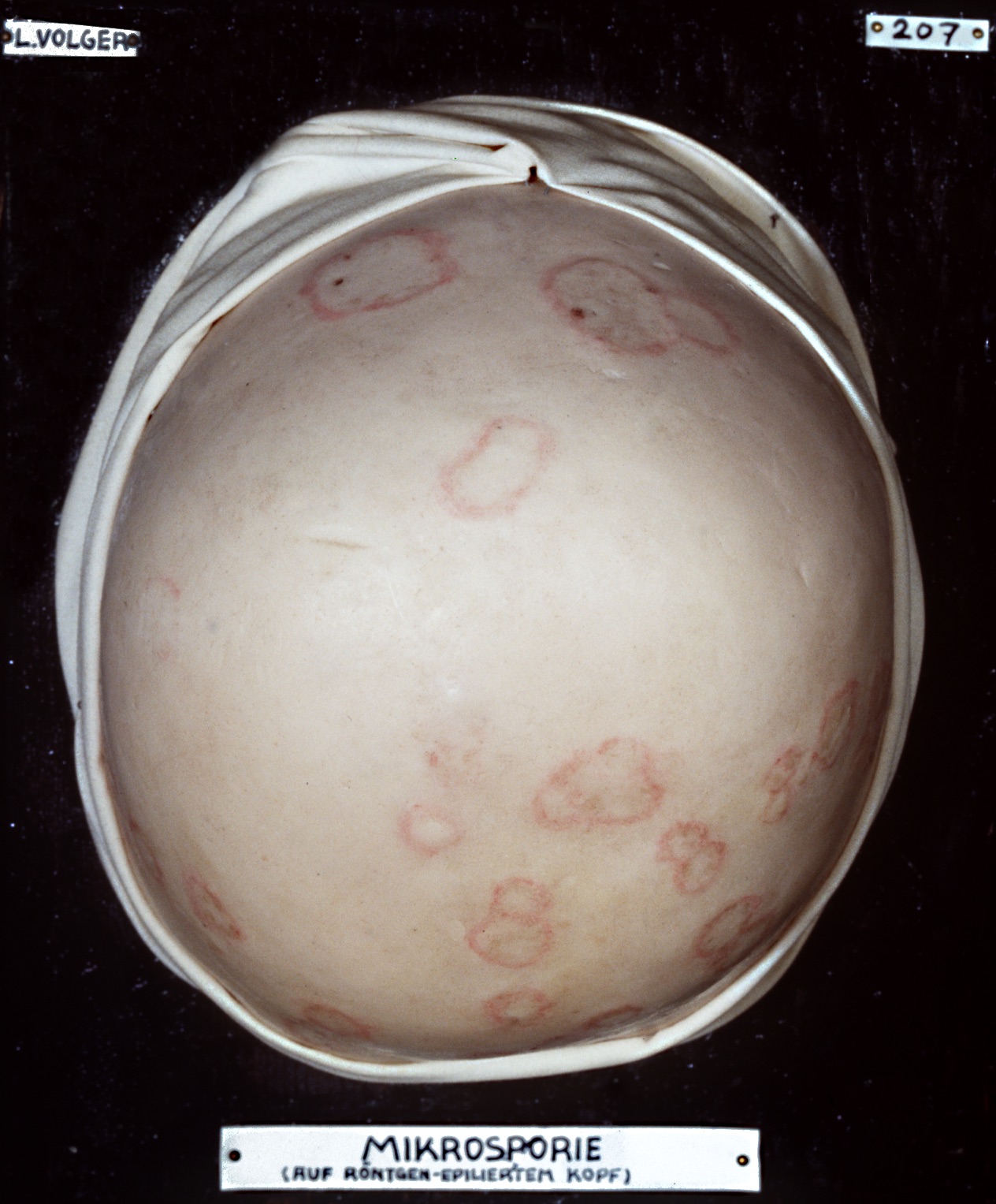 Röntgenepilierter Kopf eines Jugendlichen mit einer Pilzinfektion (Mikrosporie)